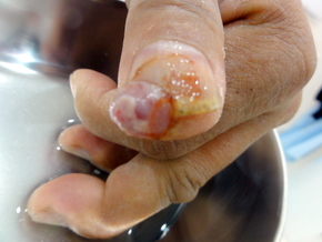 症例16 親指のひょう疽 皮下膿瘍 つかもと内科